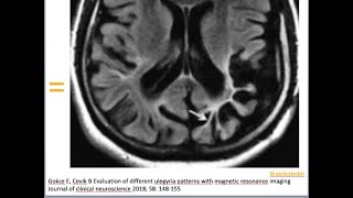 11 Ulegyria term neonate hypoxia subcortical leukomalacia brain damage epilepsy [upl. by Karee]