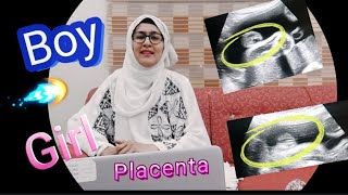 QAs  Anterior Placenta means baby Girl  Posterior Placenta means baby GirlBoy  Fundal Placenta [upl. by Edmonds]