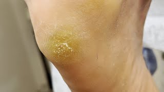 Professional treating cracked  Cracked treatment amp Callus removal  ASMR [upl. by Ynaffyt]