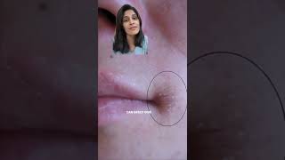 Mouth corner cracks and dryness treatment skincaretips dermatologist hyderabad [upl. by Annoif]