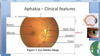 Ophthalmology 047 b Aphakia Clinical features [upl. by Namielus]