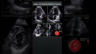 Shorts Reduced LV GLS with normal LVEF in a patient with CAD [upl. by Relyat524]