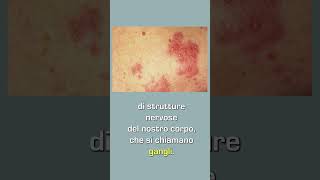 Nevralgia posterpetica e quotfuoco di SanAntonioquot Dott Antonio Musio neurochirurgo herpeszoster [upl. by Anyrb569]