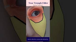 Tear Trough Eye filler  nonsurgical eyebag treatment [upl. by Harvison]