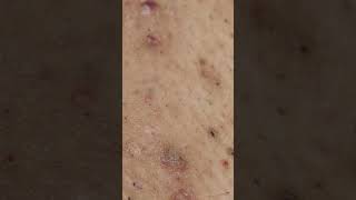 Bikini Ingrown hair removal See Transformation [upl. by Gayl210]