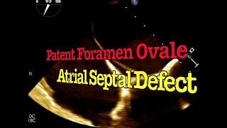 Patent Foramen Ovale PFO and Atrial Septal Defect ASD [upl. by Atiner258]