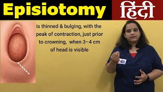 Episiotomy in Hindi  Perineotomy  Nursing Lecture [upl. by Yrahcaz15]