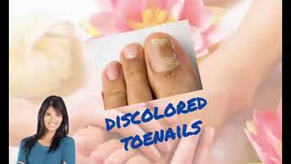 Repair Damaged Toenail Bed With Natural Treatments Products amp More [upl. by Giavani]