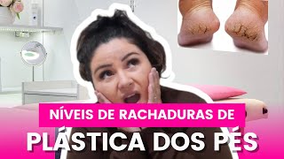 Níveis de Rachadura de Plástica dos Pés  Tudo que você precisa saber [upl. by Eylrac]