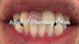 Internal Bleaching Cases [upl. by Ailecnarf954]