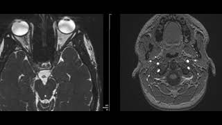 case 22 diplopia and squint [upl. by Abey988]