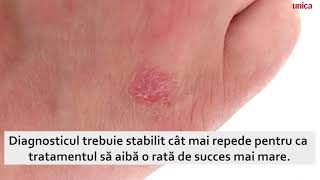 Artrita psoriazică Simptome și tratament [upl. by Eelrihs219]