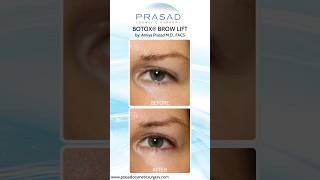 Different Types of Brow Lifts Including NonSurgical Using Botox eyebrows [upl. by Gefell]