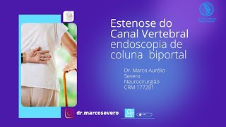 Estenose do canal vertebral e hérnia de disco lombar tratadas com endoscopia de coluna biportal [upl. by Lekym988]