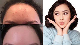 Fungal Acne  Tiny Bumps On Forehead  My Progress and Treatment [upl. by Guild710]