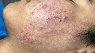 ACNE TREATMENT VU QUYNH MI Acne On Teens Cheek 2024 [upl. by Giraldo804]