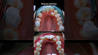 4 year braces Transformation 🥵orthodontist braces shorts [upl. by Bronnie]