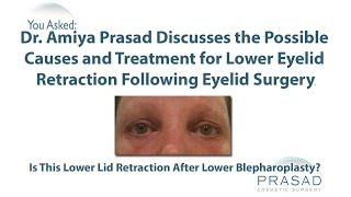 The Causes of Pulled Down Eyelids After Surgery from Temporary to Needing an Oculofacial Specialist [upl. by Elyk250]