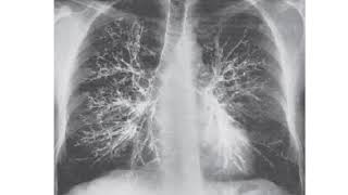 Posteroanterior bronchogram of chest [upl. by Kahl]