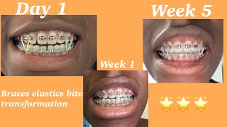 5 weeks of consistent braces elastics usage [upl. by Roter]