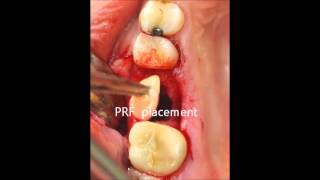 oroantral fistula closure [upl. by Madlen891]