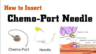 How to insert ChemoPort needle in Hindi  ChemoPort insertion Procedure  ChemoPort handling [upl. by Tsirc]