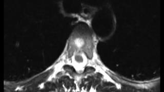 Typical and Atypical Hemangioma [upl. by Yemiaj]