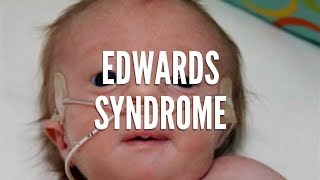 What Is Edwards Syndrome [upl. by Nadroj457]