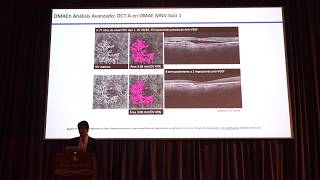 Dr Anibal Francone • Biomarcadores en OCT y Brolucizumab lo nuevo en maculopatía húmeda [upl. by Chrisoula655]