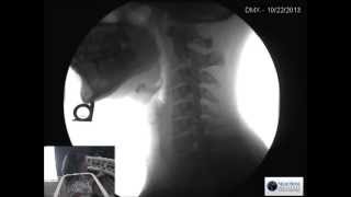 Digital Motion XRay DMX New at the NeuroSpine Institute Live XRay [upl. by Enaffit]