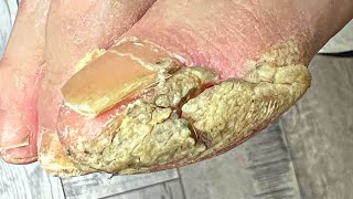 Trimming Extremely THICK And Cracked Callus [upl. by Huxley]