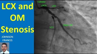 LCX and OM Stenosis [upl. by Adarbil827]