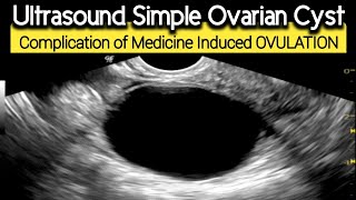 Ultrasound Simple Ovarian CYST  Complication of Medication induced Ovulation [upl. by Wellington]