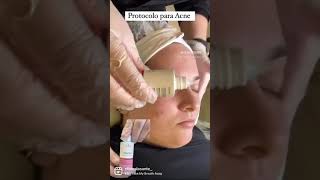 Protocolo para Acne Tulipia [upl. by Analem825]