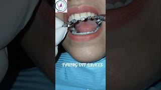 Fixed braces removal dentist orthodontics dentalbraces tooth islamabad rawalpindi [upl. by Haye815]