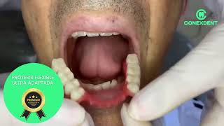 PRÓTESIS DENTAL parcial flexible alta estética PREMIUM999 [upl. by Durno794]