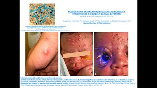 HUMAN M pox Monkeypox Infection And Morbidity Persist Since The Recent Global Outbreak [upl. by Bazar]