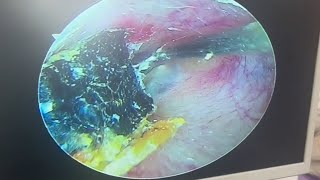 Hard cerumen embolism and dry slice cleaning earwax Cleaning earwaxremoval satisfying [upl. by Nica290]