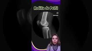 ¿Por qué tenés que angular en la RX de rodilla de P [upl. by Yeuh43]