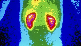 A Man Took 1176 Ibuprofen Tablets In A Month This Is What Happened To His Kidneys [upl. by Chow]