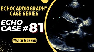 ECHO CASE 81  Echocardiography Spot Diagnosis Series  Echocardiogram Interpretation made easy [upl. by Marline]