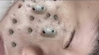 Big Cystic Acne Blackheads Extraction Blackheads amp Milia Whiteheads Removal Pimple Popping  5687 [upl. by Yul488]