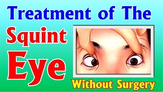 Squint Eye Treatment without Surgery I आँख के भेंगेपन की समस्या का उपचारबिना सर्जरी I Acupressure [upl. by Anidnamra]