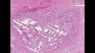 Histopathology ProstateAdenocarcinoma Gleason grade 1 [upl. by Silecara]