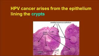 HPV and Oropharynx Part 1 [upl. by Campney]