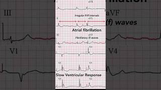 Hypothermia ECG Rhythm abnormalities [upl. by Eellehs547]