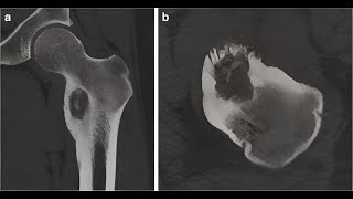 The Doctors Guide to Understanding Osteoblastoma [upl. by Junina519]