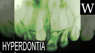 HYPERDONTIA  WikiVidi Documentary [upl. by Ebanreb]