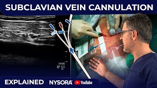 TECHNIQUE OF SUBCLAVIAN LINE AND TRIPLE LUMEN CATHETER INSERTION WITH ULTRASOUND GUIDANCE [upl. by Maje]