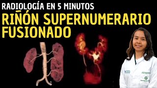 Radiología en 5 minutos Riñón Supernumerario Fusionado [upl. by Selimah]